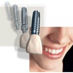 single tooth implant