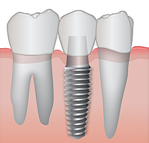 implantdentistry