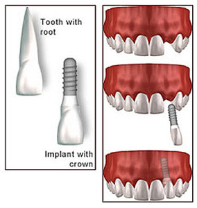 dental implant procedure