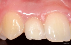 Single Tooth Implant